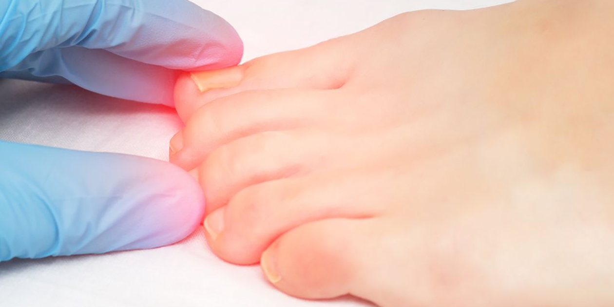 Hammertoe Referral l Podiatry Associates of Indiana