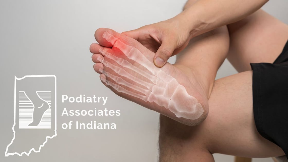 Do Bunions Always Need Surgery?